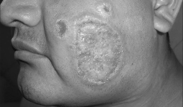 Alerta en Chinacota por aumento de casos de leishmaniasis