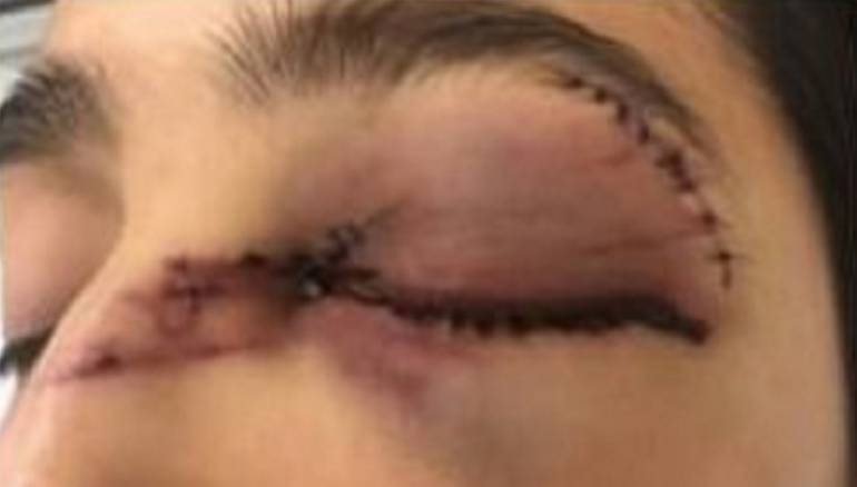 A cirugía mujer golpeada brutalmente por su esposo en Barranquilla