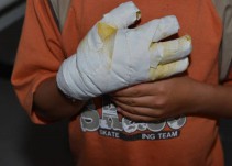 Icbf ya amonestó a padres de familia, por menores quemados pólvora, Quindío
