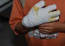 A 14 se elevó el número de quemados con pólvora en el Quindío