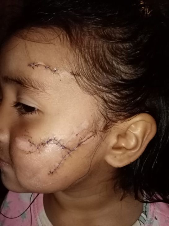 Perro pitbull atacó a niña de tres años en el sur de Bogotá Perro pitbull atacó a niña de tres años en el sur de Bogotá