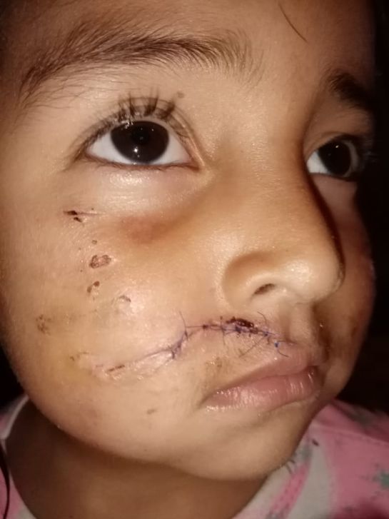 Perro pitbull atacó a niña de tres años en el sur de Bogotá Perro pitbull atacó a niña de tres años en el sur de Bogotá