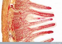 Enfermedad inflamatoria intestinal no es curable pero se puede controlar
