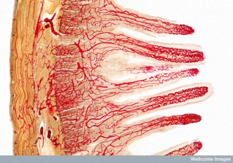 Enfermedad Inflamatoria Intestinal: Enfermedad inflamatoria intestinal no es curable pero se puede controlar