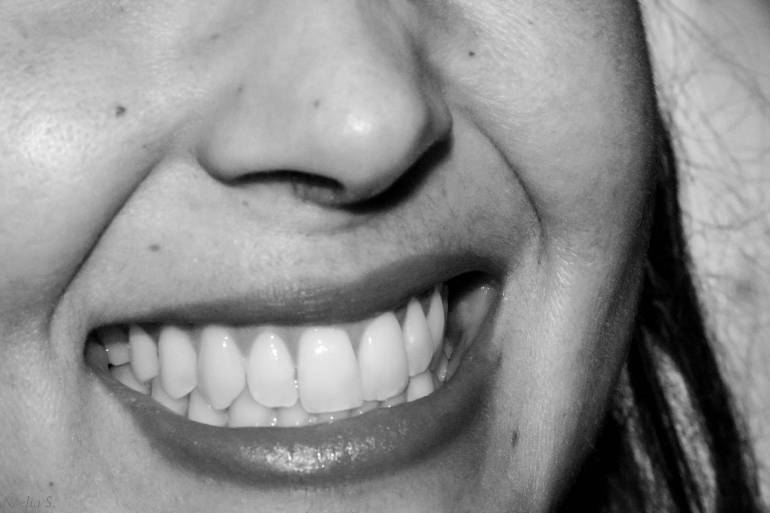 Aclaramiento Express: Aclaramiento Express, la tendencia en estética dental