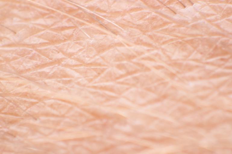 Epidermólisis Bullosa: Fundación Urgo llega para apoyar a pacientes con piel de mariposa