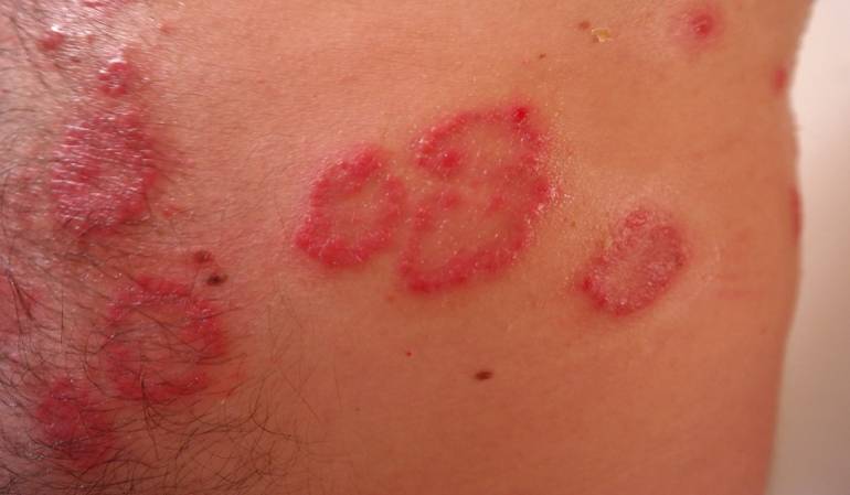 Lo Más Caracol: Qué es, cómo tratar y los efectos de la dermatitis