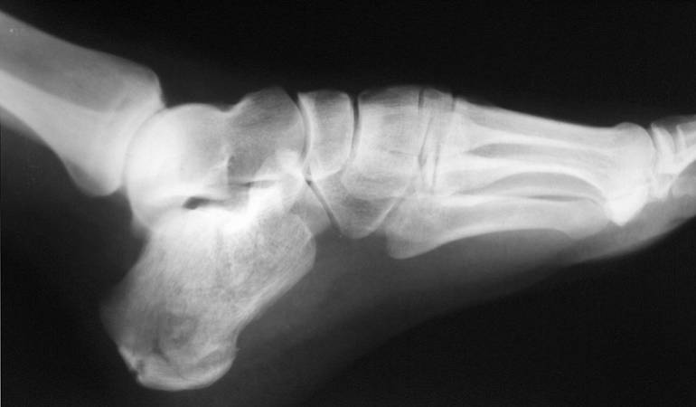 Lo Más Caracol: La osteoporosis causas y efectos
