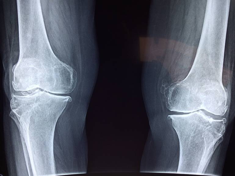 La Asociación Colombiana de Osteoporosis presentó el II Consenso Colombiano de Osteoporosis