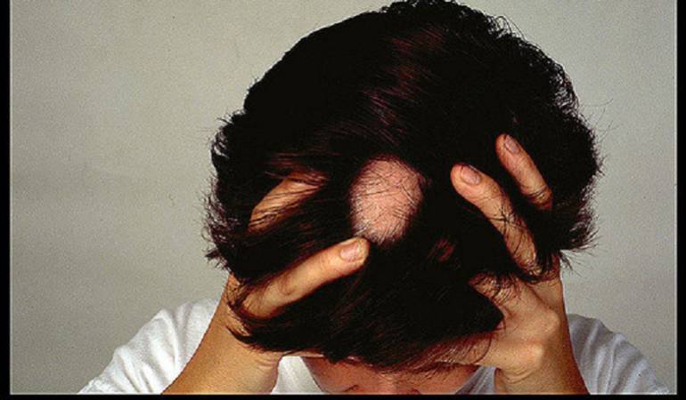 Lo Más Caracol: La Alopecia no es solo la caída del cabello