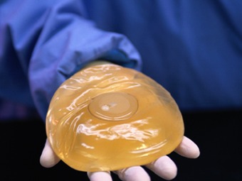 Más de 30 mil mujeres podrían tener implantes defectuosos en Francia