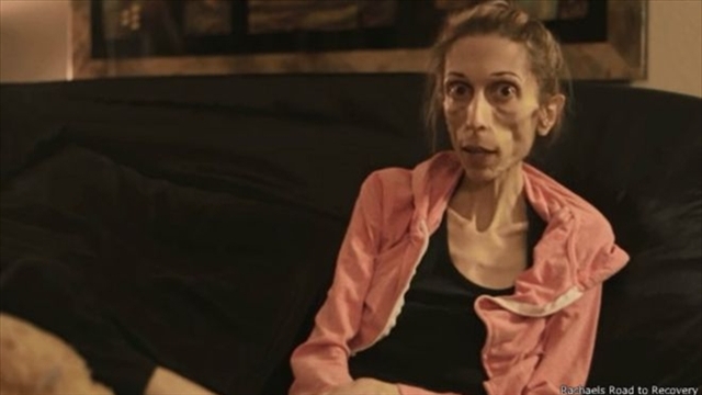 Mujer de 20 kilos pide ayuda para sobrevivir a la anorexia