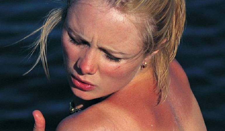 Consejos para las quemaduras de la piel: Cómo debes tratar tu piel si te quemaste con el sol