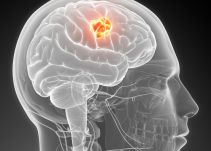 Tecnología con láser revoluciona la extracción de tumores cerebrales