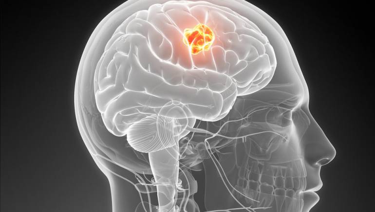Tecnología con láser revoluciona la extracción de tumores cerebrales