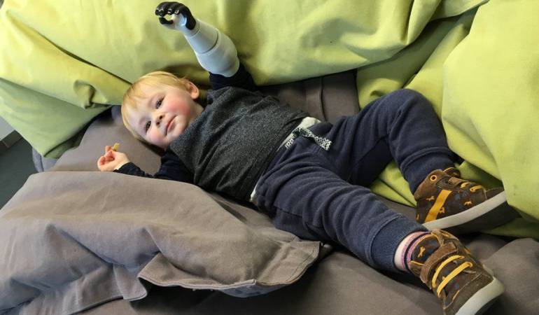 Sol, que tiene dos años, sufrió una amputación de su brazo izquierdo a los diez días de vida.