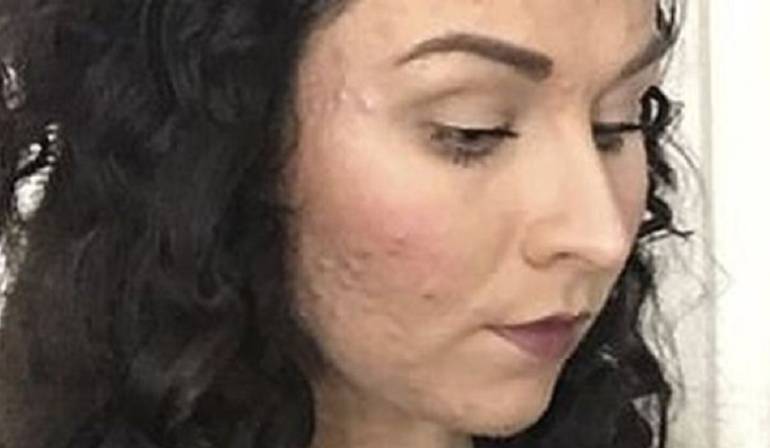Acné severo: La joven a la que le apareció acné severo de un día para otro