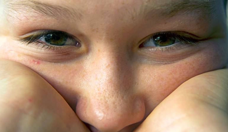 Acné en los jóvenes: La mayoría de jóvenes que sufren acné llegan a pensar en el suicidio
