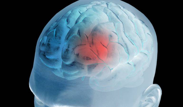Se estima que en un 25% de los casos de derrame cerebral afecta a gente joven.