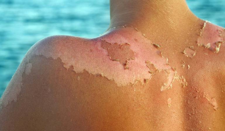 Exponerse demasiado al sol o hacerlo sin la protección adecuada puede tener consecuencias desagradables...
