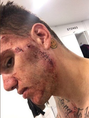 Ederson: Ederson mostró su rostro luego de la fuerte patada de Mané Ederson: Ederson mostró su rostro luego de la fuerte patada de Mané