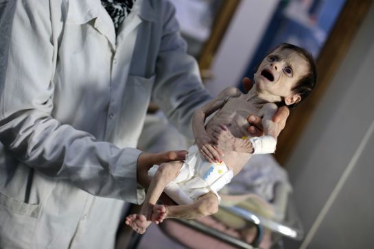 La niña de dos años sufría de un caso severo de desnutrición. La niña de dos años sufría de un caso severo de desnutrición.