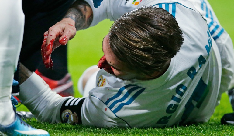 Lesión Sergio Ramos: Sergio Ramos tiene una fractura del hueso de la nariz