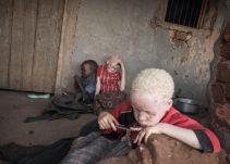 Aumenta en Mozambique el tráfico de huesos de niños albinos