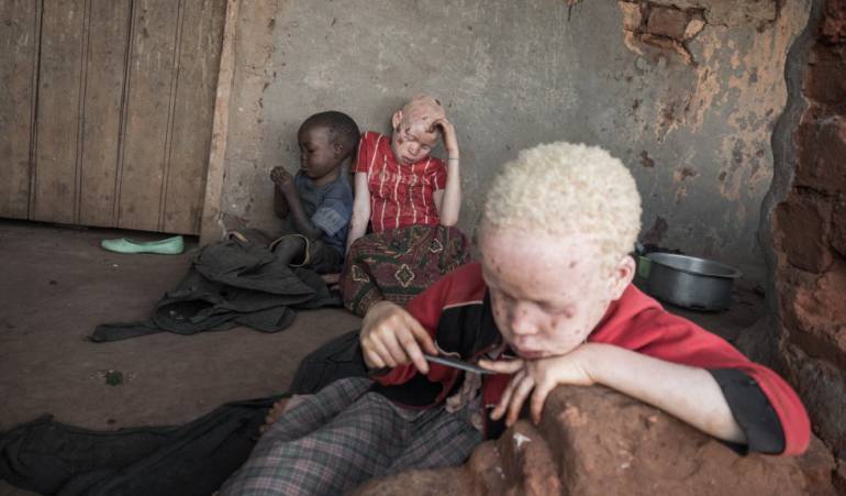 Enfermedades: Aumenta en Mozambique el tráfico de huesos de niños albinos