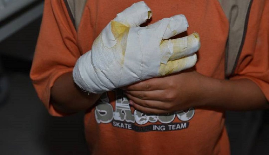 Quemados por la Pólvora Valle: A 58 llegó el número de quemados por la Pólvora en el Valle. 23 en Cali