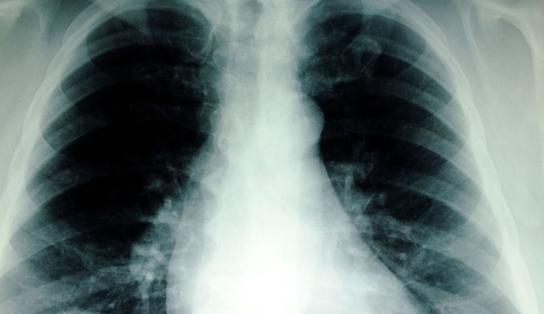 Enfermedades respiratorias: Seis personas al día mueren por enfermedades pulmonares crónicas en Bogotá