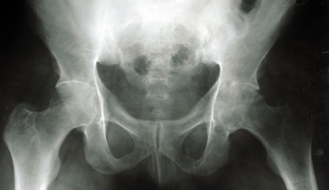 Enfermedades óseas: Conozca cómo prevenir la osteoporosis a tiempo