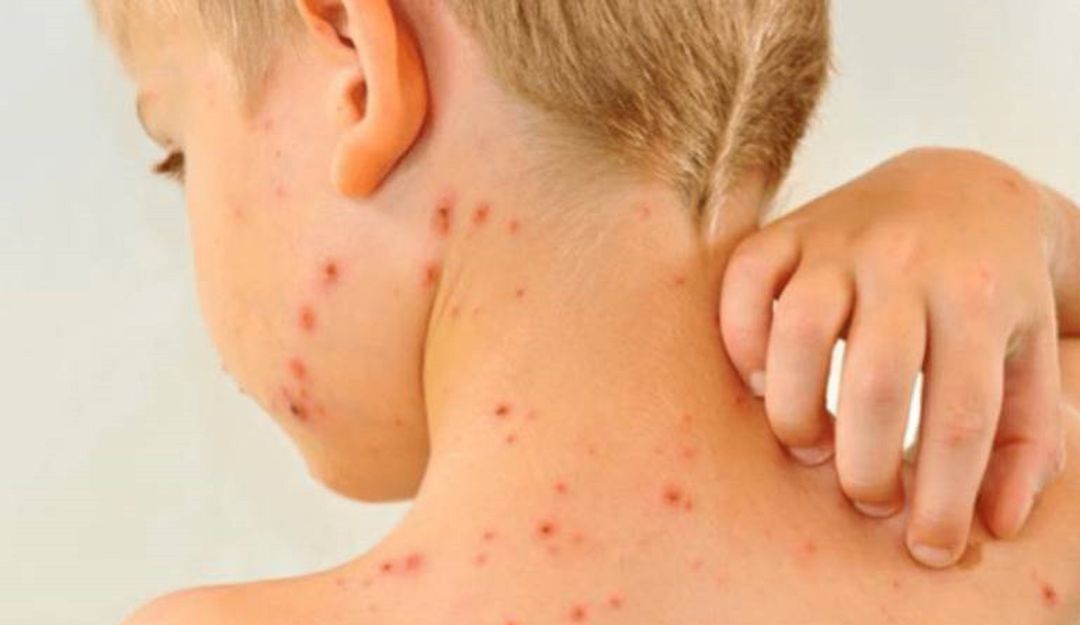 Instituciones de salud invitan a aplicarse la vacuna contra el Sarampión