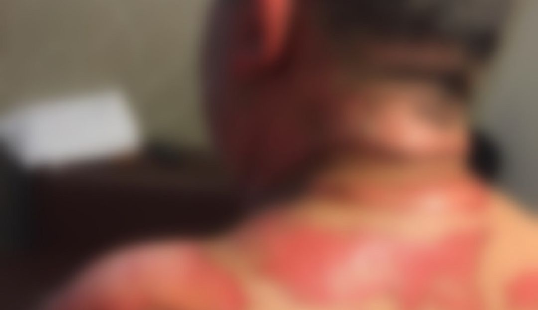 Agresión en Barranquilla: Mujer le prendió fuego a su pareja por celos