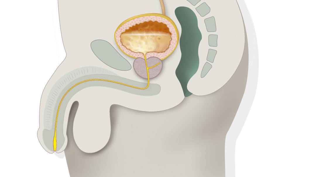 Cáncer de próstata