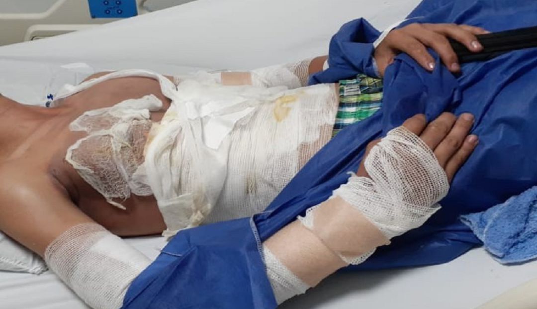 Joven que sufrió descarga eléctrica en Ibague: Se logró el traslado de joven que sufrió descarga eléctrica