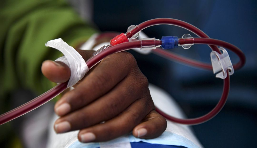 Transplante de riñones en Francia y Estados Unidos: Francia salva vidas al transplantar riñones de personas viejas