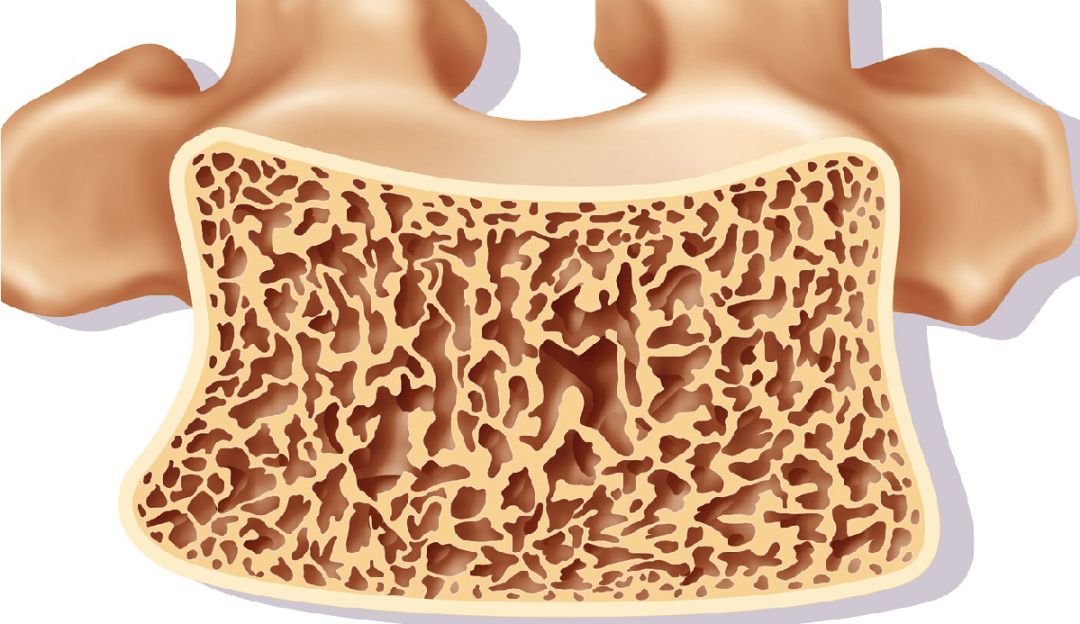 Osteoporosis: Cómo evitar y tratar la Osteoporosis