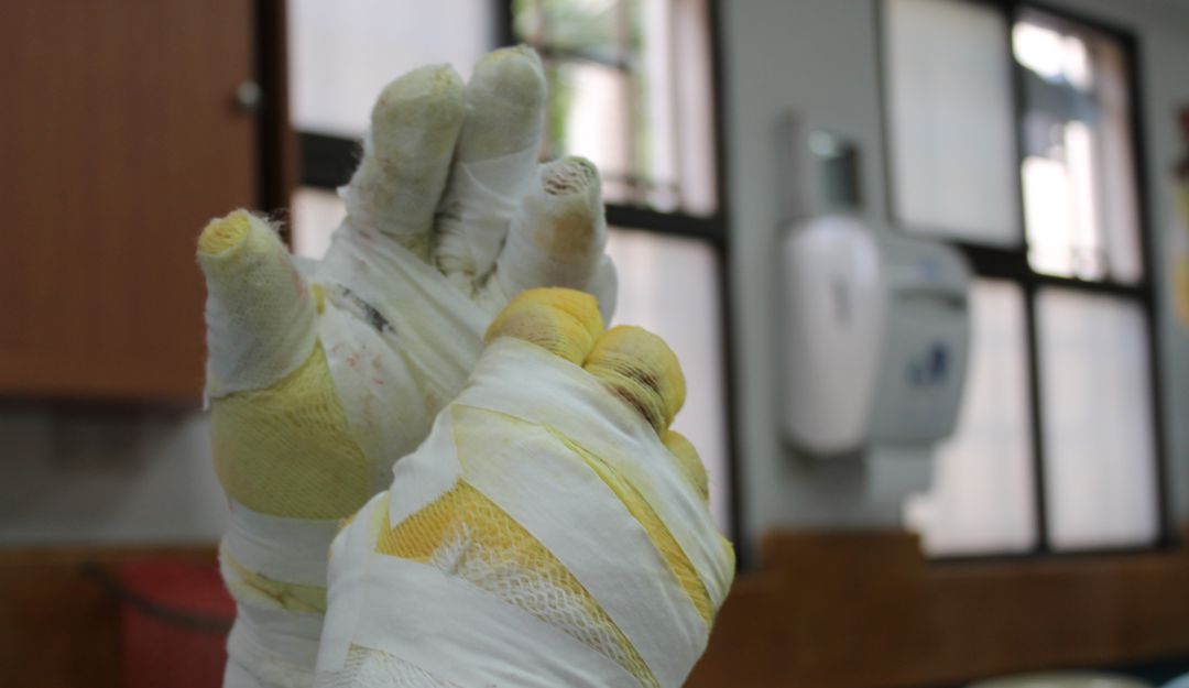 Previo a Navidad, cuatro nuevos quemados con pólvora en Antioquia