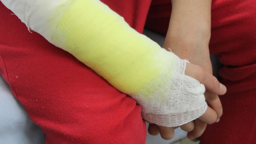 Niña de 2 años intoxicada en Caldas por ingerir pólvora