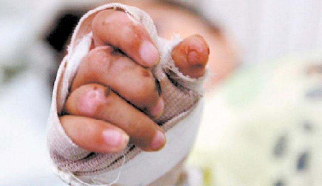PRIMER MENOR EDAD QUEMADO POLVORA SANTANDER: Primer niño quemado con pólvora esta temporada