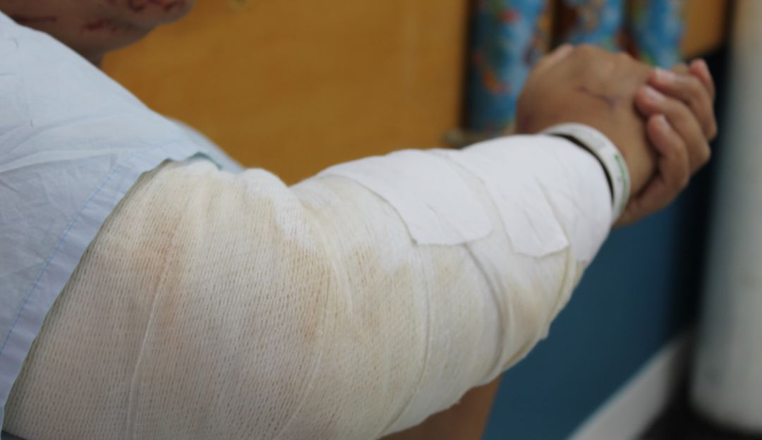 Menor de 15 años quemado en Antioquia: Un adolescente de 15 años, último quemado en Antioquia