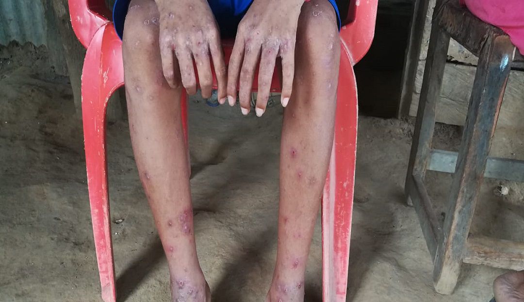 Montería, sarna, escabiosis, médicos voluntarios, corregimientos: Brote de sarna afecta a los habitantes de tres corregimientos de Montería