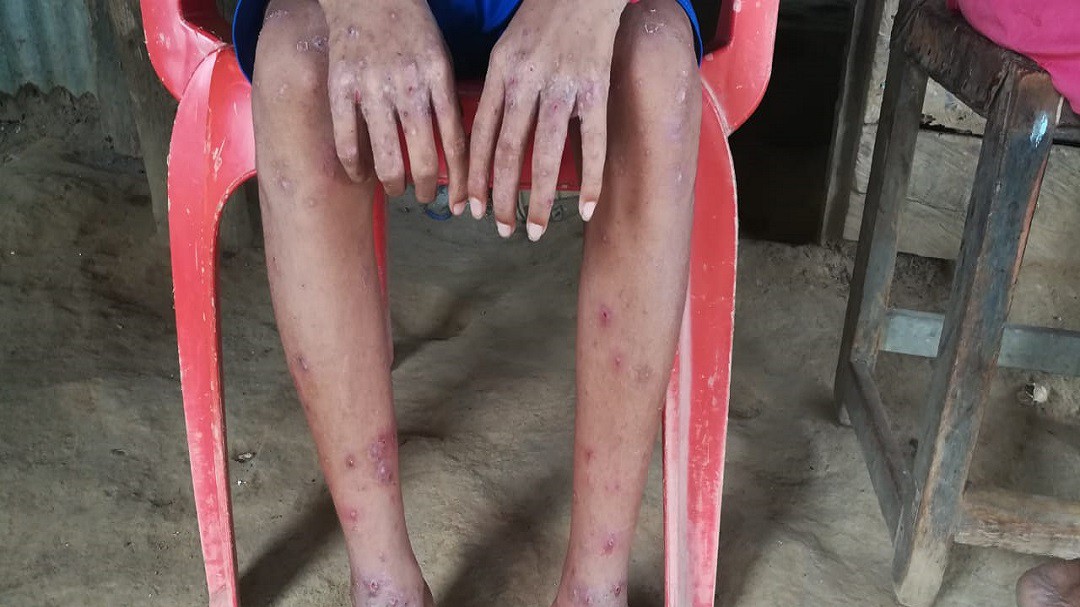 Brote de sarna afecta a los habitantes de tres corregimientos de Montería