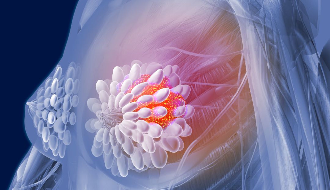 Inteligencia artificial diagnostica con más precisión el cáncer de mama: Estudio: la inteligencia artificial ayudaría a diagnosticar cáncer de mama