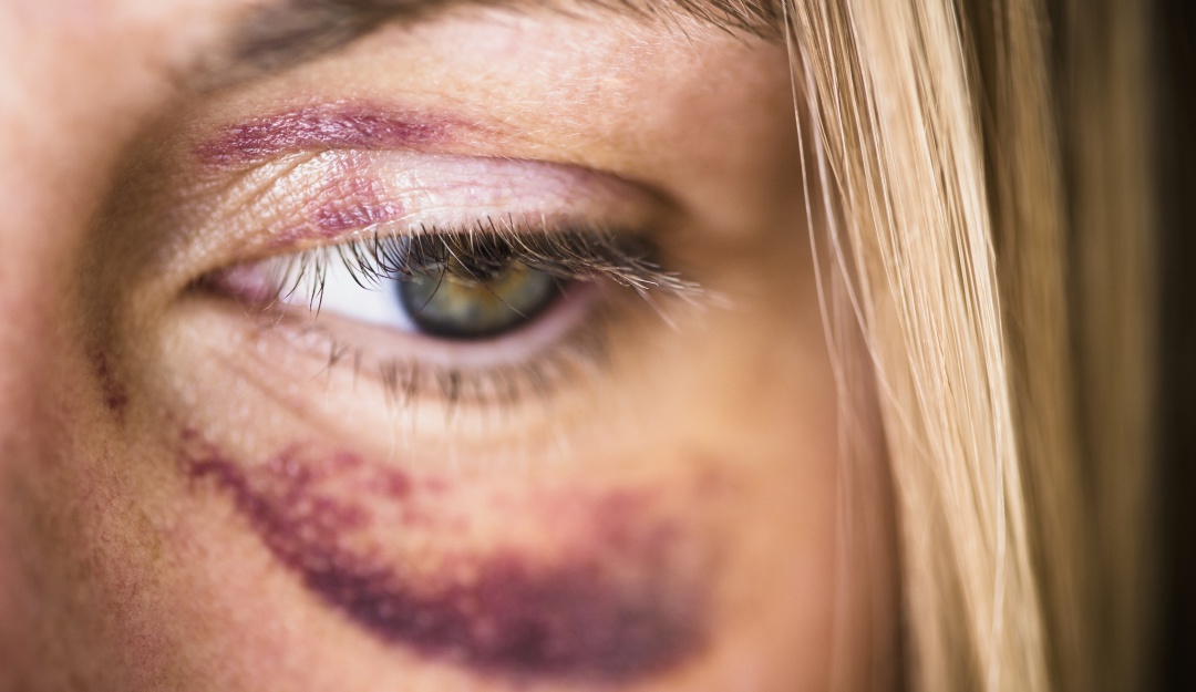 Violencia intrafamiliar Micheli Schlosser: ¿Amor? Mujer besó a expareja que intentó matarla con cinco disparos