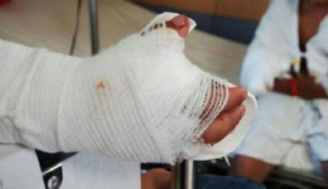 Hombre quemó a su pareja sentimental: En coma mujer que fue quemada por su pareja en Barranquilla