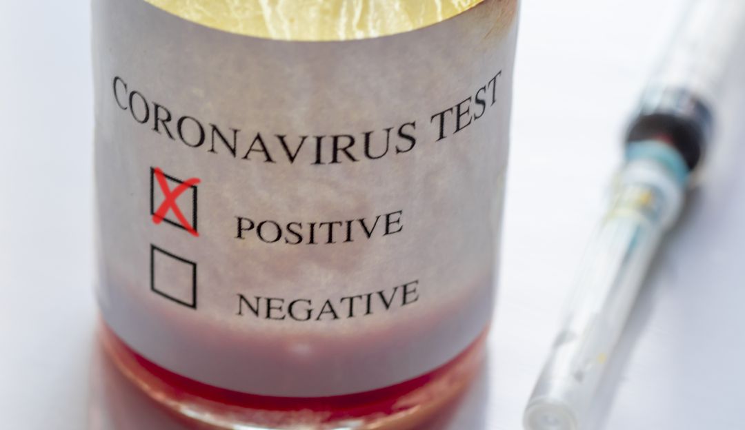 Pruebas de laboratorio COVID-19: En Sucre se podrán hacer pruebas de coronavirus