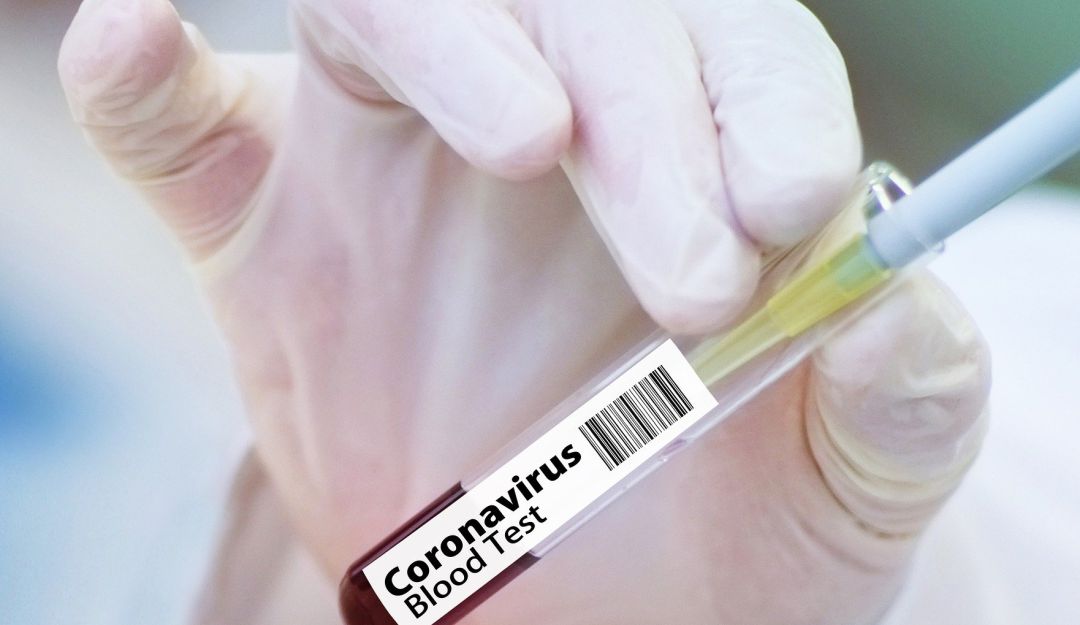 Noticias Bogotá: Se hará más de 400 mil test de Covid-19 entre abril y mayo: Bogotá hará más de 400.000 pruebas para Covid-19 entre abril y mayo