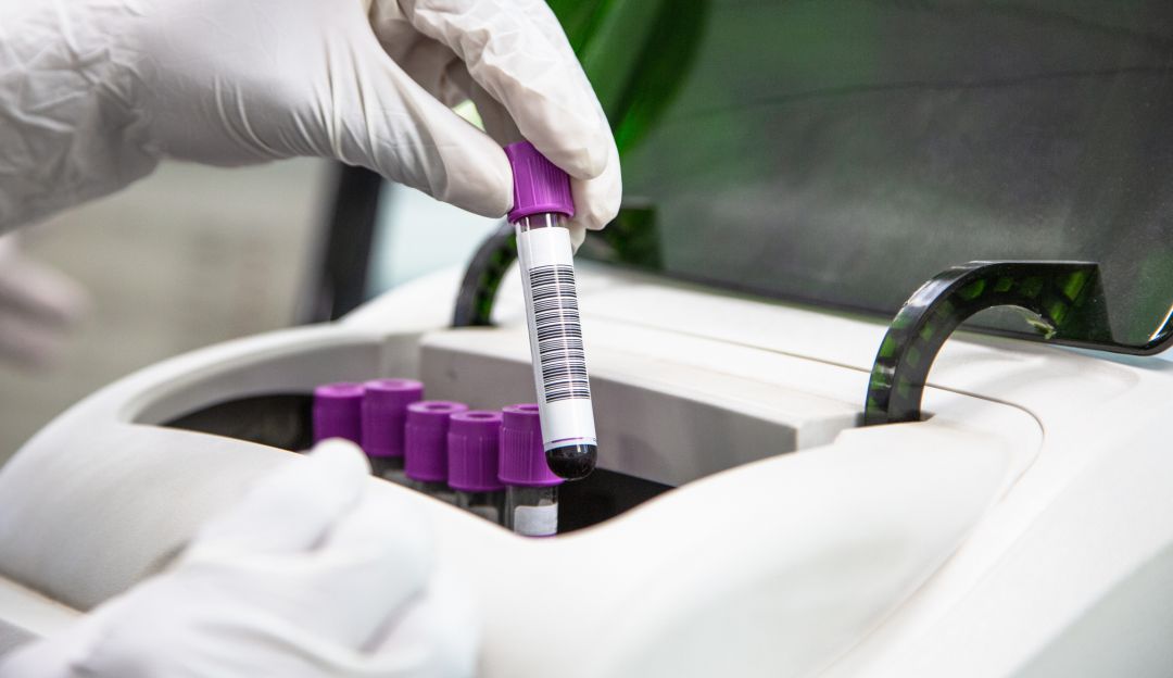 Efetividad del plasma coronavirus: Estudio piloto encontró un 80% de efectividad del plasma contra COVID-19